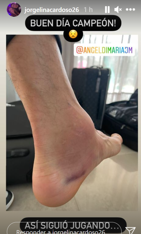 Así le quedó el tobillo a Di María tras la final Así le quedó el tobillo a Di María tras la final